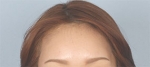 Banobagi Plastic Surgery,Reviews,Images, Promotions, MISOODA — Korea cost, reviews & before-after | MISOODA
