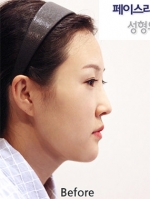 Faceline Plastic Surgery, Reviews,Images,Promotions — Korea cost, reviews & before-after | MISOODA