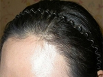 Mojelin Hair Transplant,Reviews,Images, Promotions — Korea cost, reviews & before-after | MISOODA