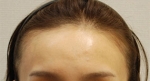 Yonsei Hair transplant Plastic Surgery, Reviews,Images, Promotions — Korea cost, reviews & before-after | MISOODA