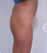 The Plastic Surgery, Reviews,Images, Promotions, — Korea cost, reviews & before-after | MISOODA