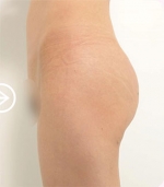 The Plastic Surgery, Reviews,Images, Promotions, — Korea cost, reviews & before-after | MISOODA