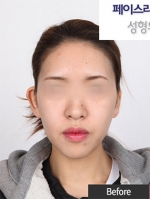 Faceline Plastic Surgery, Reviews,Images,Promotions — Korea cost, reviews & before-after | MISOODA