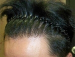 Mojelin Hair Transplant,Reviews,Images, Promotions — Korea cost, reviews & before-after | MISOODA