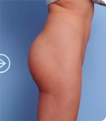 The Plastic Surgery, Reviews,Images, Promotions, — Korea cost, reviews & before-after | MISOODA