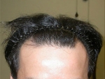 Mojelin Hair Transplant,Reviews,Images, Promotions — Korea cost, reviews & before-after | MISOODA