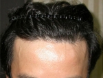Mojelin Hair Transplant,Reviews,Images, Promotions — Korea cost, reviews & before-after | MISOODA