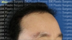 BK Plastic Surgery, Reviews, Images, Promotions — Korea cost, reviews & before-after | MISOODA