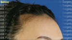 BK Plastic Surgery, Reviews, Images, Promotions — Korea cost, reviews & before-after | MISOODA