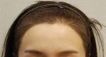 Yonsei Hair transplant Plastic Surgery, Reviews,Images, Promotions — Korea cost, reviews & before-after | MISOODA