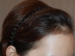 Mojelin Hair Transplant,Reviews,Images, Promotions — Korea cost, reviews & before-after | MISOODA