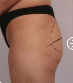 The Plastic Surgery, Reviews,Images, Promotions, — Korea cost, reviews & before-after | MISOODA