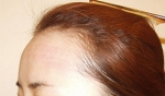 Yonsei Hair transplant Plastic Surgery, Reviews,Images, Promotions — Korea cost, reviews & before-after | MISOODA
