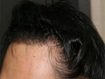 Mojelin Hair Transplant,Reviews,Images, Promotions — Korea cost, reviews & before-after | MISOODA