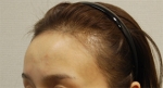 Yonsei Hair transplant Plastic Surgery, Reviews,Images, Promotions — Korea cost, reviews & before-after | MISOODA