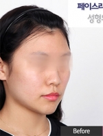 Faceline Plastic Surgery, Reviews,Images,Promotions — Korea cost, reviews & before-after | MISOODA