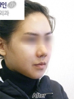 Faceline Plastic Surgery, Reviews,Images,Promotions — Korea cost, reviews & before-after | MISOODA