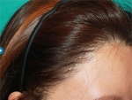 Mojelin Hair Transplant,Reviews,Images, Promotions — Korea cost, reviews & before-after | MISOODA