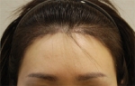 Yonsei Hair transplant Plastic Surgery, Reviews,Images, Promotions — Korea cost, reviews & before-after | MISOODA