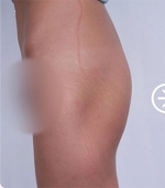 The Plastic Surgery, Reviews,Images, Promotions, — Korea cost, reviews & before-after | MISOODA