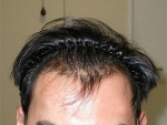 Mojelin Hair Transplant,Reviews,Images, Promotions — Korea cost, reviews & before-after | MISOODA