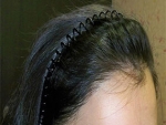 Mojelin Hair Transplant,Reviews,Images, Promotions — Korea cost, reviews & before-after | MISOODA
