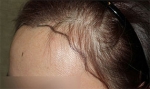 Mojelin Hair Transplant,Reviews,Images, Promotions — Korea cost, reviews & before-after | MISOODA