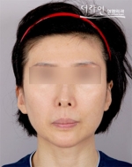 Theline Plastic Surgery,Reviews,Images, Promotions — Korea cost, reviews & before-after | MISOODA