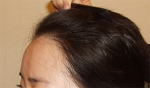 Yonsei Hair transplant Plastic Surgery, Reviews,Images, Promotions — Korea cost, reviews & before-after | MISOODA