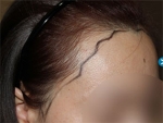 Mojelin Hair Transplant,Reviews,Images, Promotions — Korea cost, reviews & before-after | MISOODA