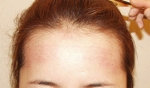 Yonsei Hair transplant Plastic Surgery, Reviews,Images, Promotions — Korea cost, reviews & before-after | MISOODA