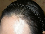 Mojelin Hair Transplant,Reviews,Images, Promotions — Korea cost, reviews & before-after | MISOODA