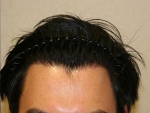 Mojelin Hair Transplant,Reviews,Images, Promotions — Korea cost, reviews & before-after | MISOODA
