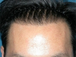 Mojelin Hair Transplant,Reviews,Images, Promotions — Korea cost, reviews & before-after | MISOODA