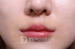 Deesse Plastic Surgery, Reviews,Images, Promotions — Korea cost, reviews & before-after | MISOODA