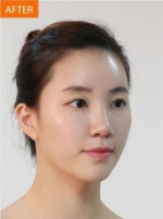 Banobagi Plastic Surgery,Reviews,Images, Promotions, MISOODA — Korea cost, reviews & before-after | MISOODA