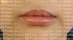 BK Plastic Surgery, Reviews, Images, Promotions — Korea cost, reviews & before-after | MISOODA