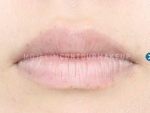 Mojelin Hair Transplant,Reviews,Images, Promotions — Korea cost, reviews & before-after | MISOODA