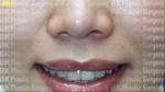 BK Plastic Surgery, Reviews, Images, Promotions — Korea cost, reviews & before-after | MISOODA