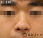 Rovl Avenue Liposuction,Reviews,Images, Promotions — Korea cost, reviews & before-after | MISOODA