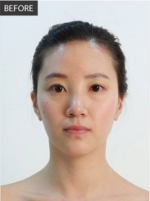 Banobagi Plastic Surgery,Reviews,Images, Promotions, MISOODA — Korea cost, reviews & before-after | MISOODA