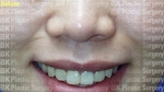 BK Plastic Surgery, Reviews, Images, Promotions — Korea cost, reviews & before-after | MISOODA