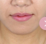 Banobagi Plastic Surgery,Reviews,Images, Promotions, MISOODA — Korea cost, reviews & before-after | MISOODA