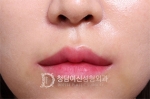 Deesse Plastic Surgery, Reviews,Images, Promotions — Korea cost, reviews & before-after | MISOODA