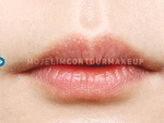 Mojelin Hair Transplant,Reviews,Images, Promotions — Korea cost, reviews & before-after | MISOODA