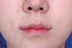 Deesse Plastic Surgery, Reviews,Images, Promotions — Korea cost, reviews & before-after | MISOODA