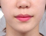 DA Plastic Surgery, Reviews, Images, Promotions — Korea cost, reviews & before-after | MISOODA