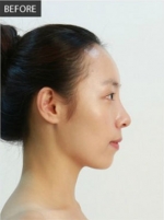 Banobagi Plastic Surgery,Reviews,Images, Promotions, MISOODA — Korea cost, reviews & before-after | MISOODA