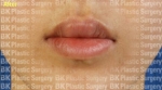 BK Plastic Surgery, Reviews, Images, Promotions — Korea cost, reviews & before-after | MISOODA