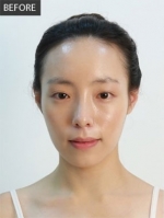 Banobagi Plastic Surgery,Reviews,Images, Promotions, MISOODA — Korea cost, reviews & before-after | MISOODA